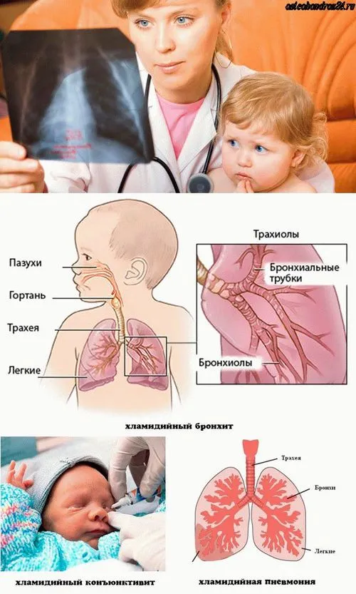 лікування хламідіозу у дітей