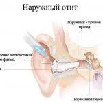 хронічний фарингіт нежить
