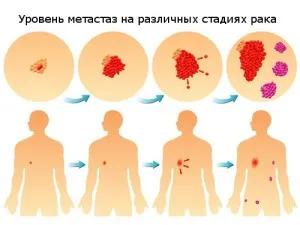 як лікувати пневмонію на ранніх стадіях