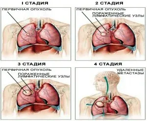 як лікувати пневмонію на ранніх стадіях