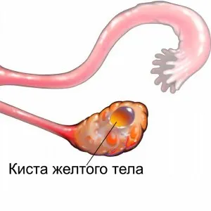 кіста жовтого тіла яєчника при вагітності