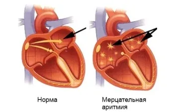 миготлива аритмія діагностика