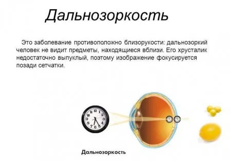 як лікувати далекозоре астигматизм
