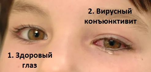 як лікувати дитині коньюктивит