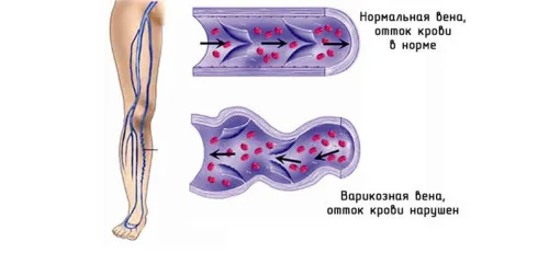 як лікувати варикоз травами