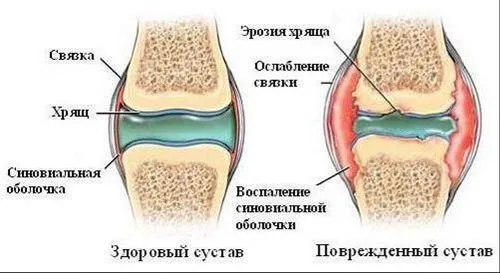 як лікувати суглоби і хребет