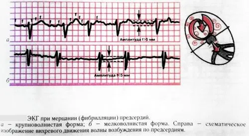 миготлива аритмія симптоми і причини