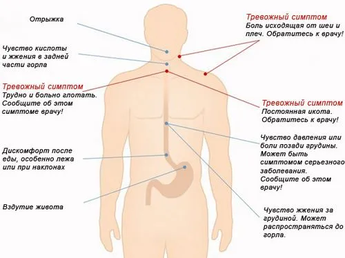 як лікувати печію ліки