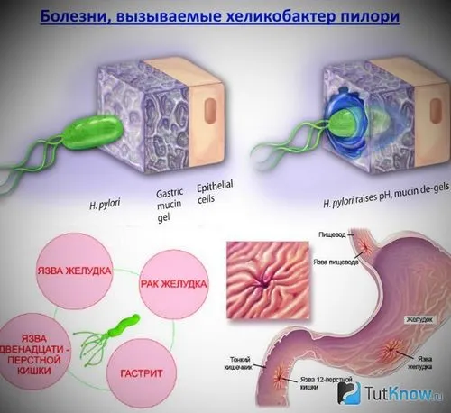 Бактерія хелікобактер бактерія