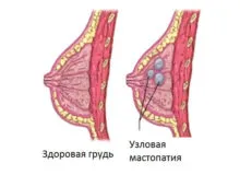 мастопатія лікувати чи ні
