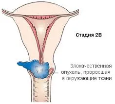 2 Стадія раку шийки матки як лікувати рак шийки матки 2 стадії