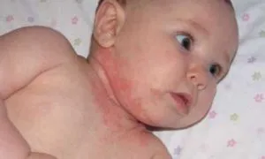 як лікувати алергічний дерматит у дитини