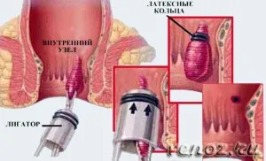 що таке геморой це лікувати фото робити після пологів недорогі свічки зовнішній хронічний