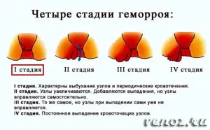 як вилікувати маленький геморой