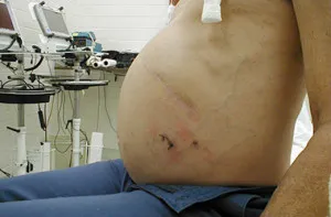 як лікувати цироз печінки і асцит