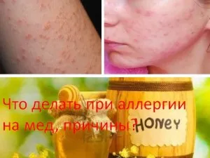 Що робити при алергії на мед, причини? лікування алергії