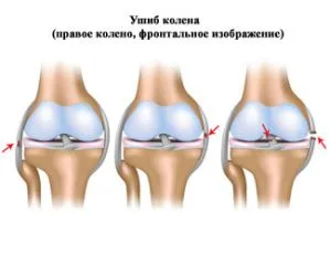 забій коліна що робити