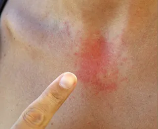 алергія сонце причина симптом лікування
