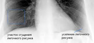 Бронхіт і пневмонія: відмінності як лікувати бронхіальну пневмонію