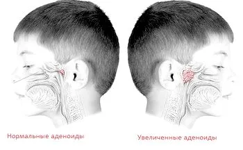аденоїди 2 ступеня у дітей: лікування або видалення