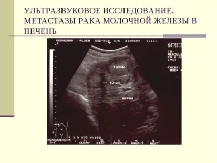 мастопатія лікувати чи ні