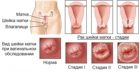 2 Стадія раку шийки матки як лікувати рак шийки матки 2 стадії