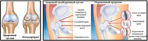 артроз і бодібілдинг