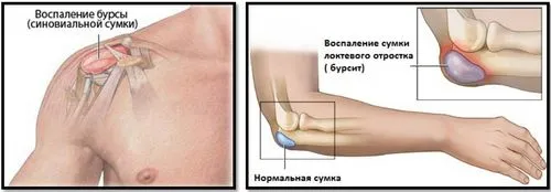 артроз і бодібілдинг
