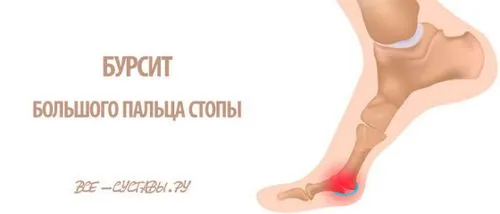 Бурсит великого пальця стопи бурсит великого пальця стопи лікування симптоми