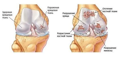 Що робити якщо хрустять суглоби? хрумтять суглоби що робити