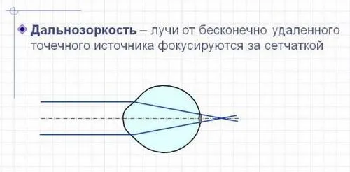 як лікувати далекозорість у дитини