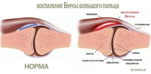 Бурсит великого пальця стопи бурсит великого пальця стопи лікування симптоми