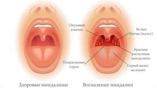 як лікувати хронічний тонзиліт без антибіотиків