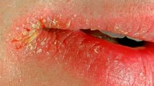 як лікувати заїди на губах народними засобами