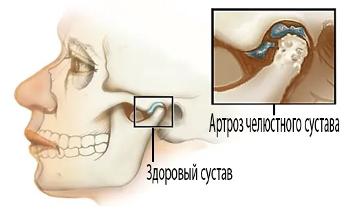 як вилікувати артроз щелепи