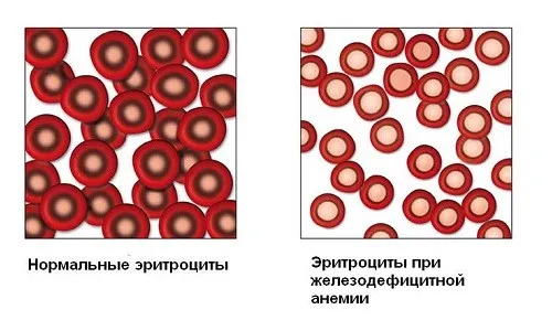 Анемія: небезпека і наслідки органи кровотворення