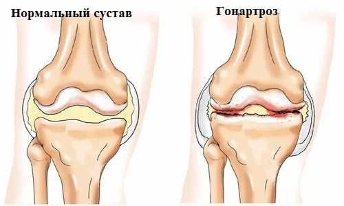 як вилікувати артроз без операції