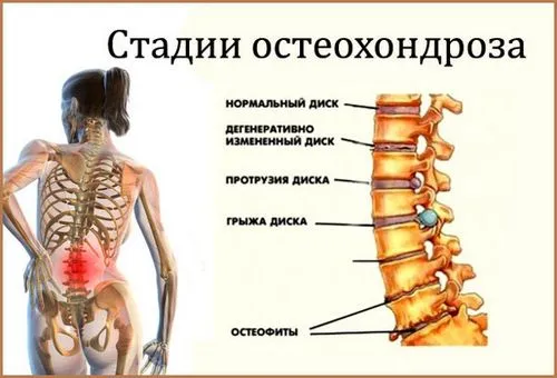 як лікувати остеохондроз шиї при вагітності