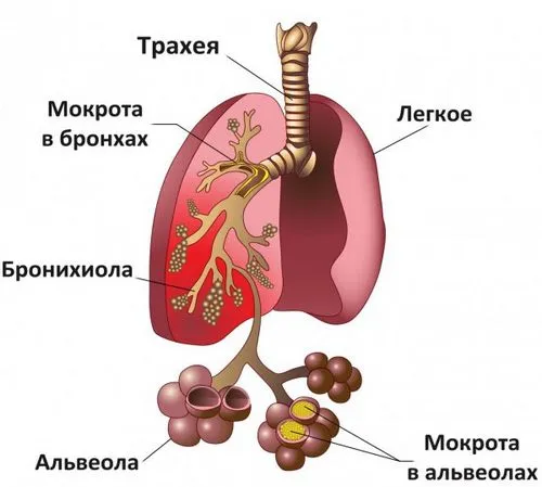 як лікувати бронхіальну пневмонію