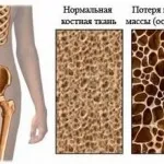 як лікувати остеопороз рук