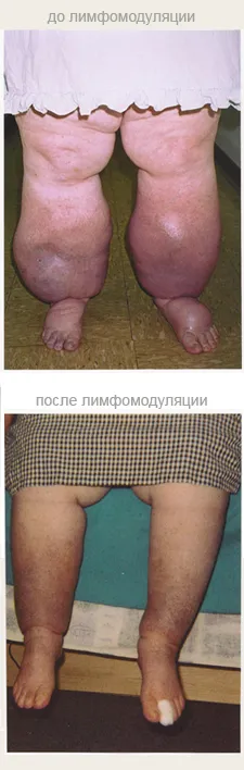 як лікувати лімфостаз при цукровому діабеті