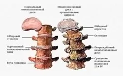 як лікувати запущений остеохондроз