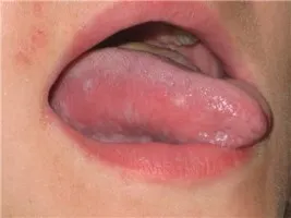 інфекція