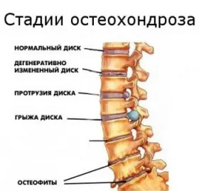 як лікувати ювенільний остеохондроз