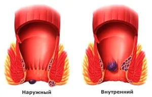 як лікувати геморой