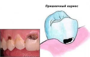 як вилікувати карієс зубів