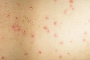 як лікувати псоріаз дьогтем
