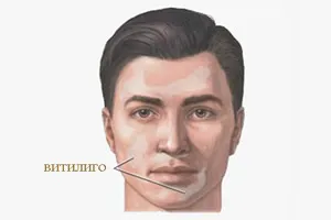 лікування вітіліго