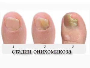 як вилікувати грибок нігтів таблетками