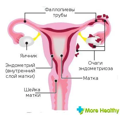 Ендометріоз 1 ступеня ендометріоз